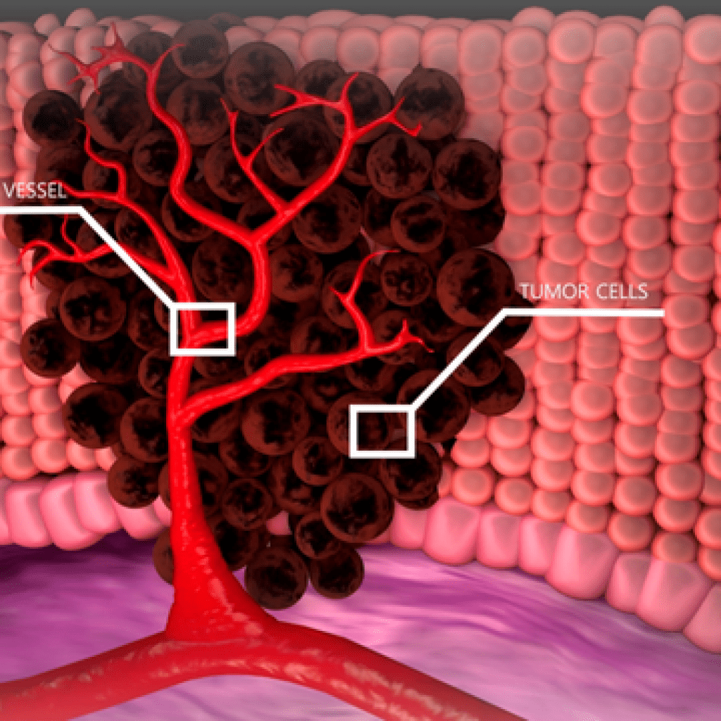 A new technique using hyperpolarization could help in detecting cancerous tumors.