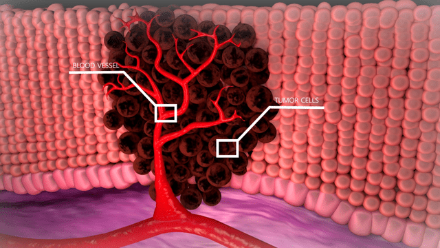 A new technique using hyperpolarization could help in detecting cancerous tumors.